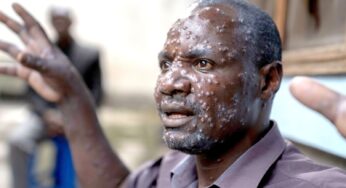 ВОЗ объявила чрезвычайную ситуацию из-за нового штамма «обезьяньей оспы»